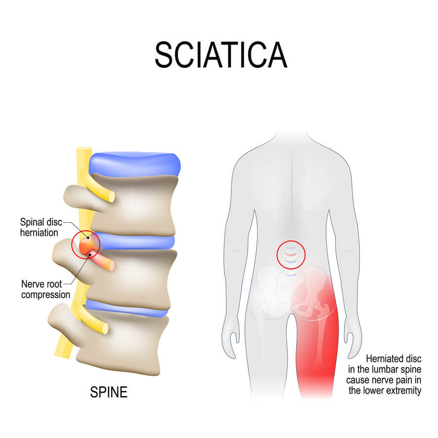 Sciatica - Synapse Pain & Spine Clinic
